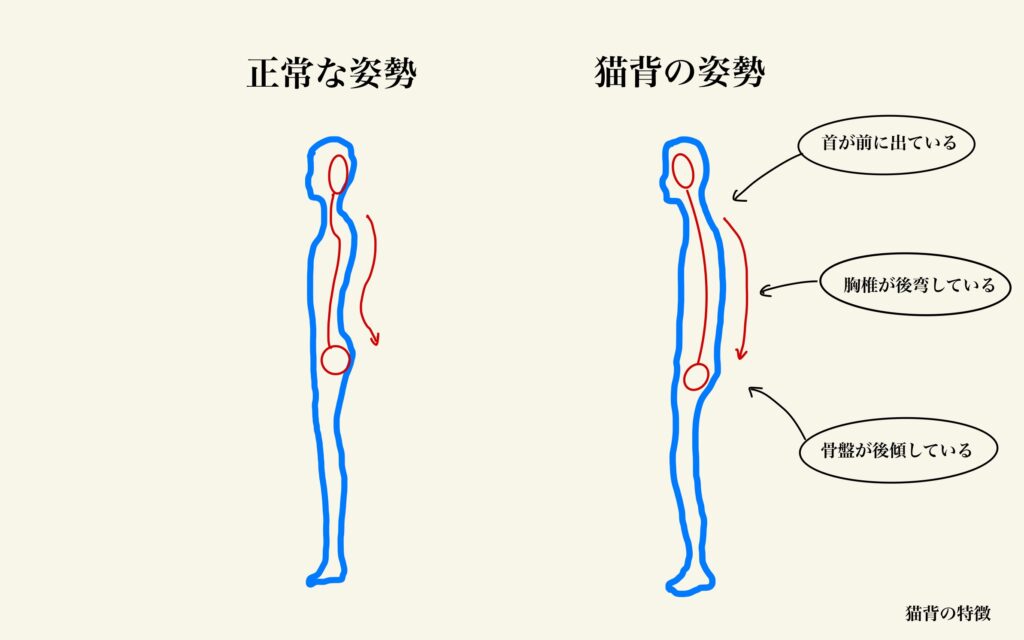 猫背の特徴を表す図解
